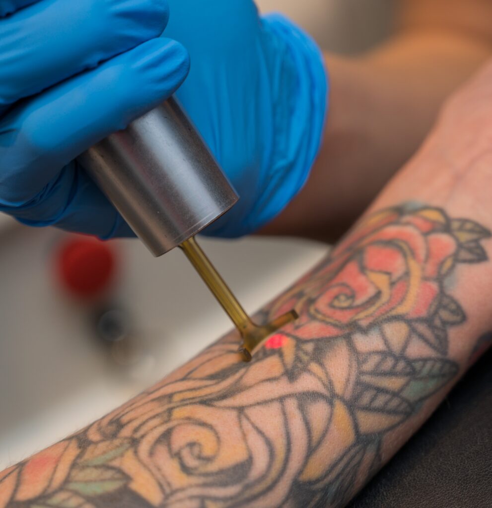Profile Image of Removery Tattoo Removal